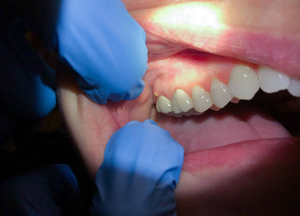 Best Emergency Dental Care for Abscessed Tooth in Man, IL